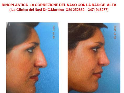 Rinoplastica La Correzione Del Naso Con La Radice Alta