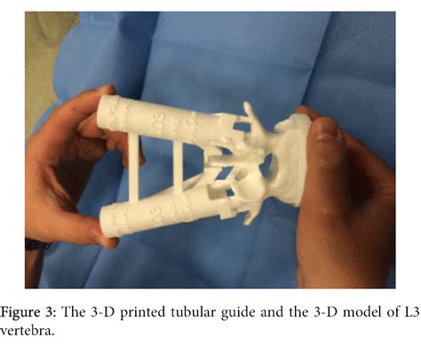 3D Printed Tubular Guides For Pedicle Screw Placement The Answer For