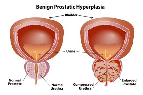 Benign Prostatic Hyperplasia Definition Causes Symptoms 44 Off