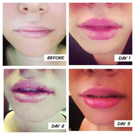 Lip Filler Swelling Stages Heres What To Expect Celebritystyleguide