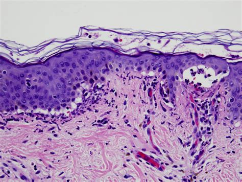 Epidermolysis Bullosa Acquisita Histology