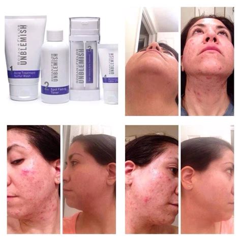 Unblemish Results Rodan And Fields Unblemish Post Acne Marks