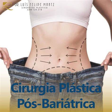 A Cirurgia Pl Stica P S Bari Trica Consiste Na Retirada Do Excesso De