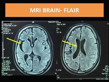 Figure A:MRI brain FLAIR axial showing prominent cortical sulci, gyri... | Download Scientific ...