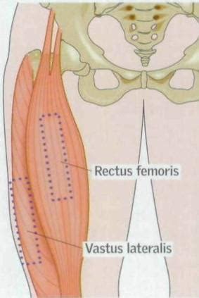 Rectus Femoris Injection Flashcards Quizlet