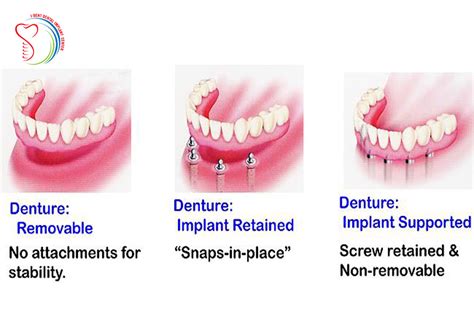 Should Choose Dental Implants Or Removable Denture