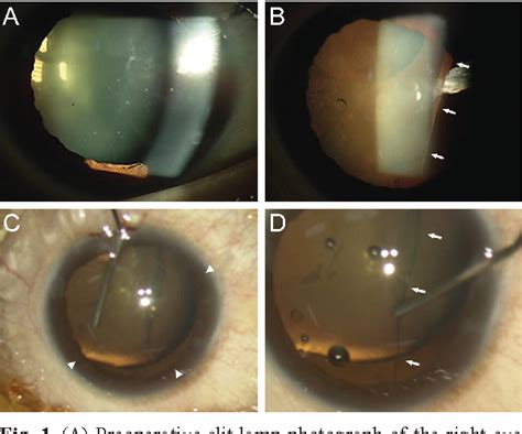 Figure From Traumatic Dislocation Of Posterior Chamber Phakic