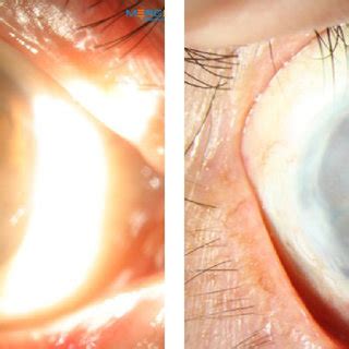 Simple Limbal Epithelial Transplantation Notes Patient With Chemical