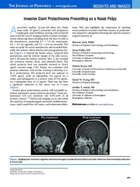 Pdf Invasive Giant Prolactinoma Presenting As A Nasal Polyp Ambika