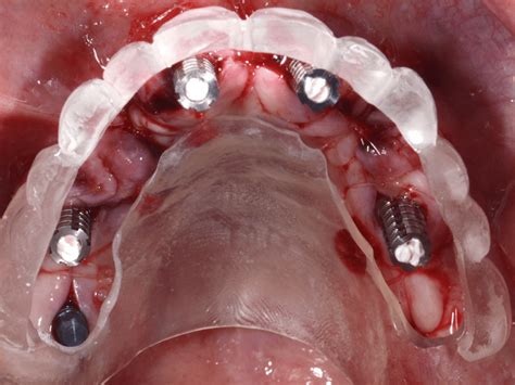 ZAGA Centers Management Of A Severely Atrophic Maxilla With Zygoma