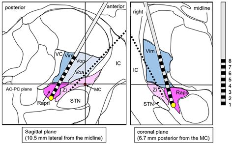 Frontiers A Case Report Dual Lead Deep Brain Stimulation Of The