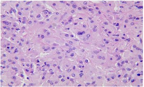 Pathology Of Left Neck Lymph Nodes Revealed Numerous Gaucher Cells He