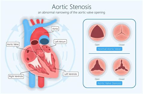 What Is The Aortic Stenosis Aortic Valve Diseases By Hearty Life Blog