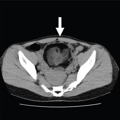 Pelvic Computed Tomography Showing A Dermoid Cyst No Malignant