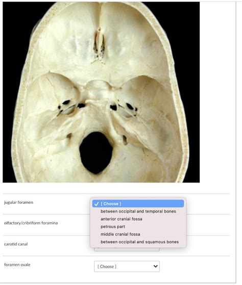 Solved Jugular Foramen Choose Between Occipital And