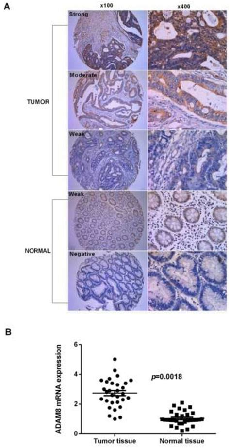 Adam8 Expression Status In Crc Tumor And Normal Tissues A Expression Download Scientific