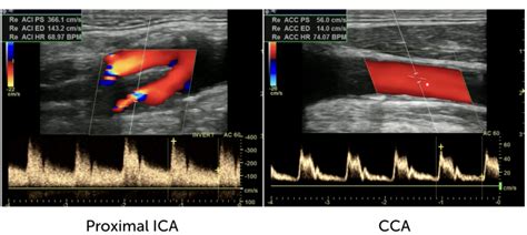 12 Carotid Artery Stenosis Part 2 Spectral Doppler 123 Sonography