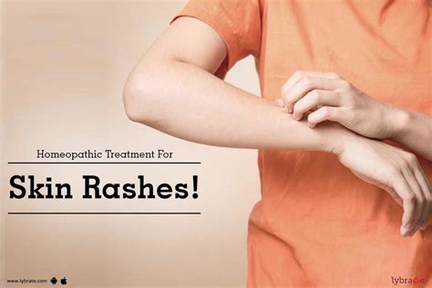 Homeopathic Treatment For Skin Rashes By Dr Ramneek Gupta Lybrate