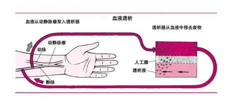 血液透析病人动静脉内瘘的保护 知乎