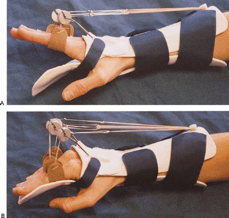 Splinting Match Diagnosis With Splint Flashcards Quizlet