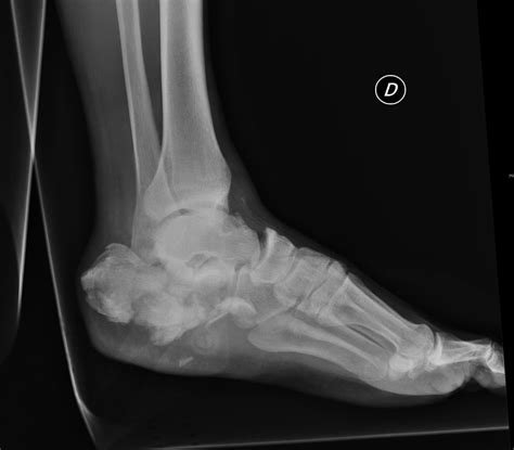 Calcaneus Fractures Trauma Orthobullets