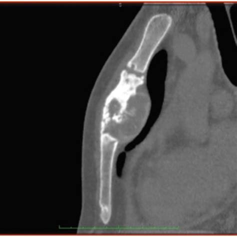 Osteomyelitis Of The Sternum In Hiv Patient Download Scientific Diagram