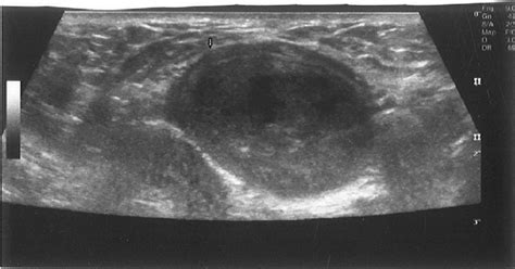 Ultrasound Guided Puncture Of The Mixed Echogenic Cystic Mass Of Left Download Scientific