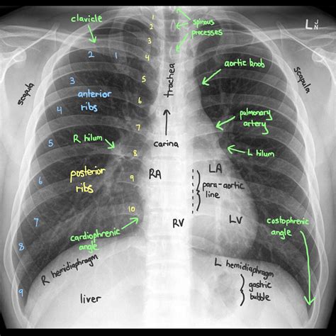 Reading Chest X Rays Artofit