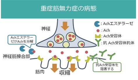 重症筋無力症 Myasthenia Gravis 臨床症状・分類・検査│医學事始 いがくことはじめ