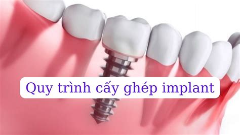 Cấy Ghép Implant Có Đau Không Cách Giảm Đau Sau Trồng Implant