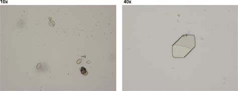 Urine Sediment Revealing Hexagonal Shaped Crystals Consistent With