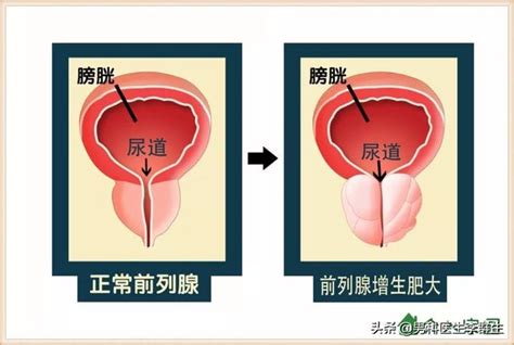 前列腺增生症和前列腺肥大是怎麼回事？ 每日頭條