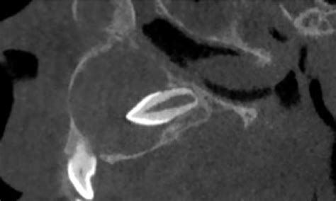 Sagittal Cone Beam Ct Showing An Anterior Maxillary Dentigerous Cyst Download Scientific