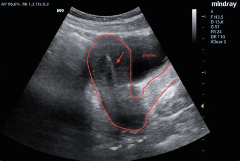 Hennepin Ultrasound | Pain after IUD Placement