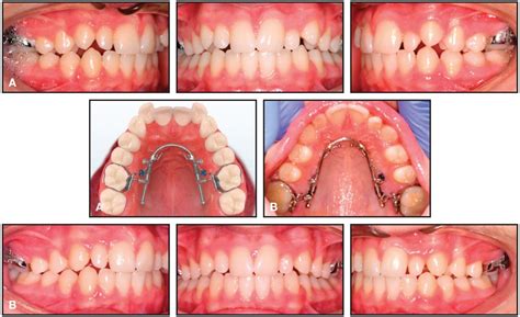 Creative Adjuncts For Clear Aligners Part 1 Class Ii Treatment Jco Online Journal Of