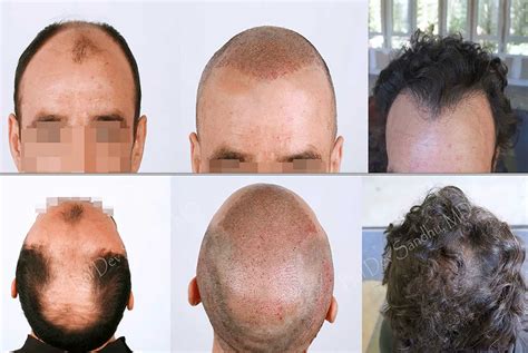 New Jersey Hair Transplant