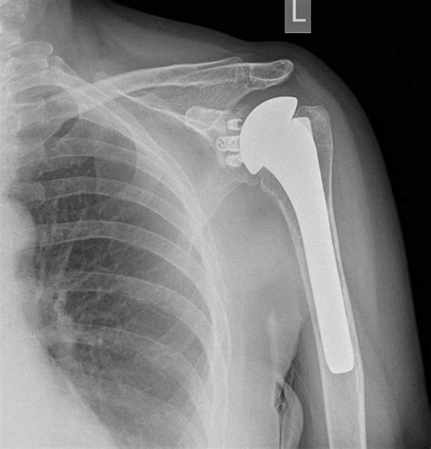 Figure Figure 1 Left Shoulder Anteroposterior Statpearls