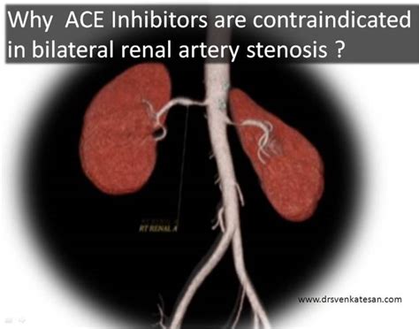 Bilateral Renal Artery Stenosis Drsvenkatesan Md