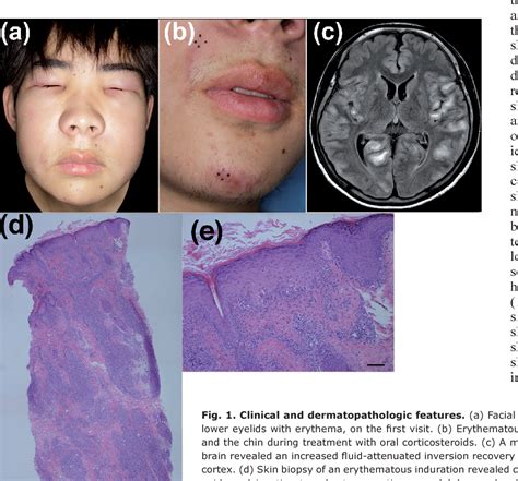 Figure From Primary Cutaneous Aggressive Epidermotropic Cd T Cell