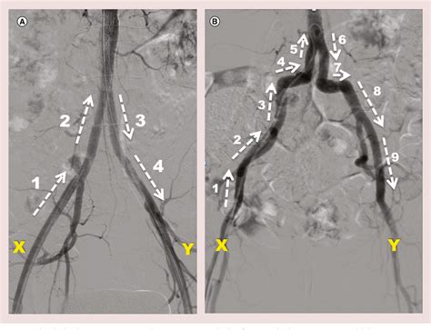 Figure 1 From Tibial Pedal Arterial Access And Retrograde Interventions For Advanced Peripheral