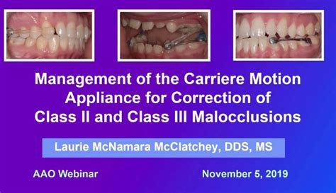 2019 Webinar Management Of The Carriere Motion Appliance Prior To