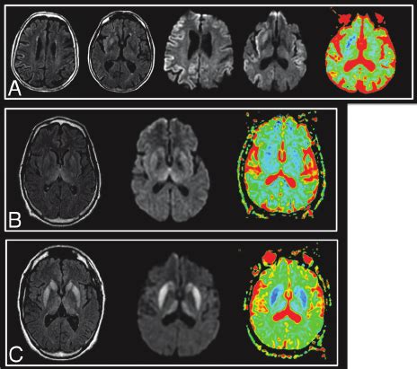 Typical Images In Cases Of Scjd A Vcjd B And Gcjd C