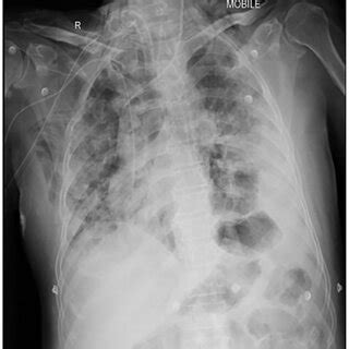 Chest X-ray of second patient showing features of ARDS, and resolving... | Download Scientific ...