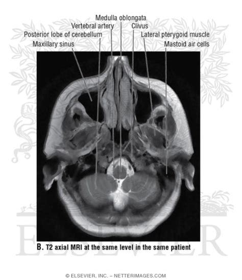 T2 Axial Mri Just Above The Foramen Magnum