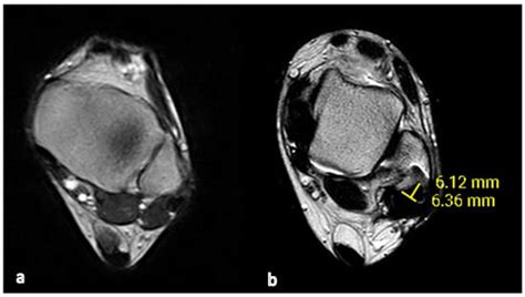 Applied Sciences Free Full Text Retromalleolar Groove Deepening In