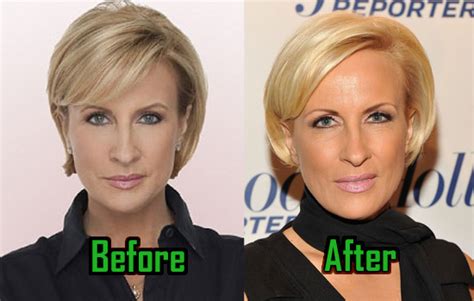 Mika Brzezinski: Plastic Surgery for Facelift? Before-After ...