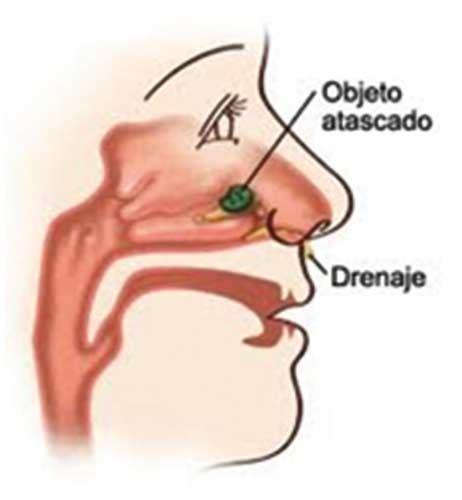 Primeros auxilios cuerpos extraños en la nariz o en los oídos