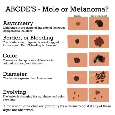 Cancerous Moles Vs Normal Moles