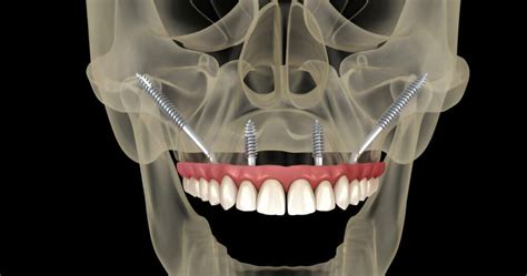 Zygomatic Dental Implants Hebedoc