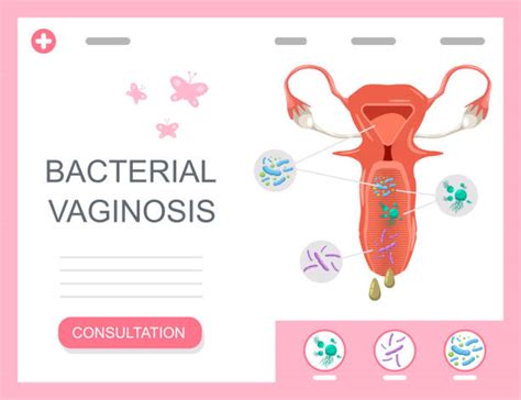 Bacterial Vaginosis Illustrations Illustrations Royalty Free Vector Graphics And Clip Art Istock